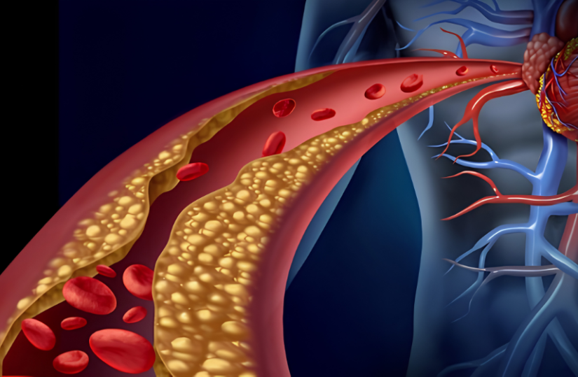 dislipidemia