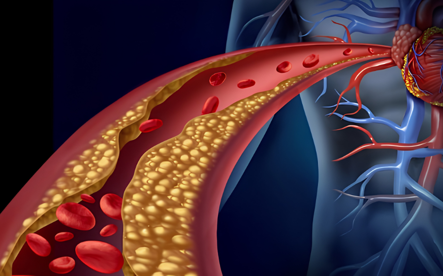 dislipidemia